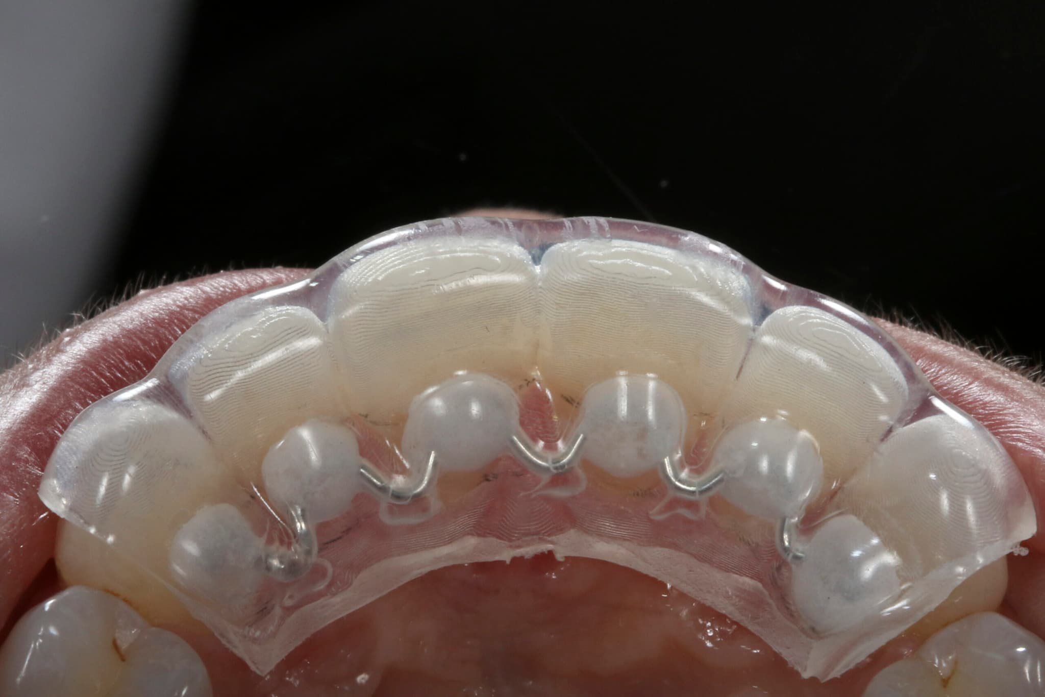 Fixed Retainer Options to Maintain Your Perfect Smile
