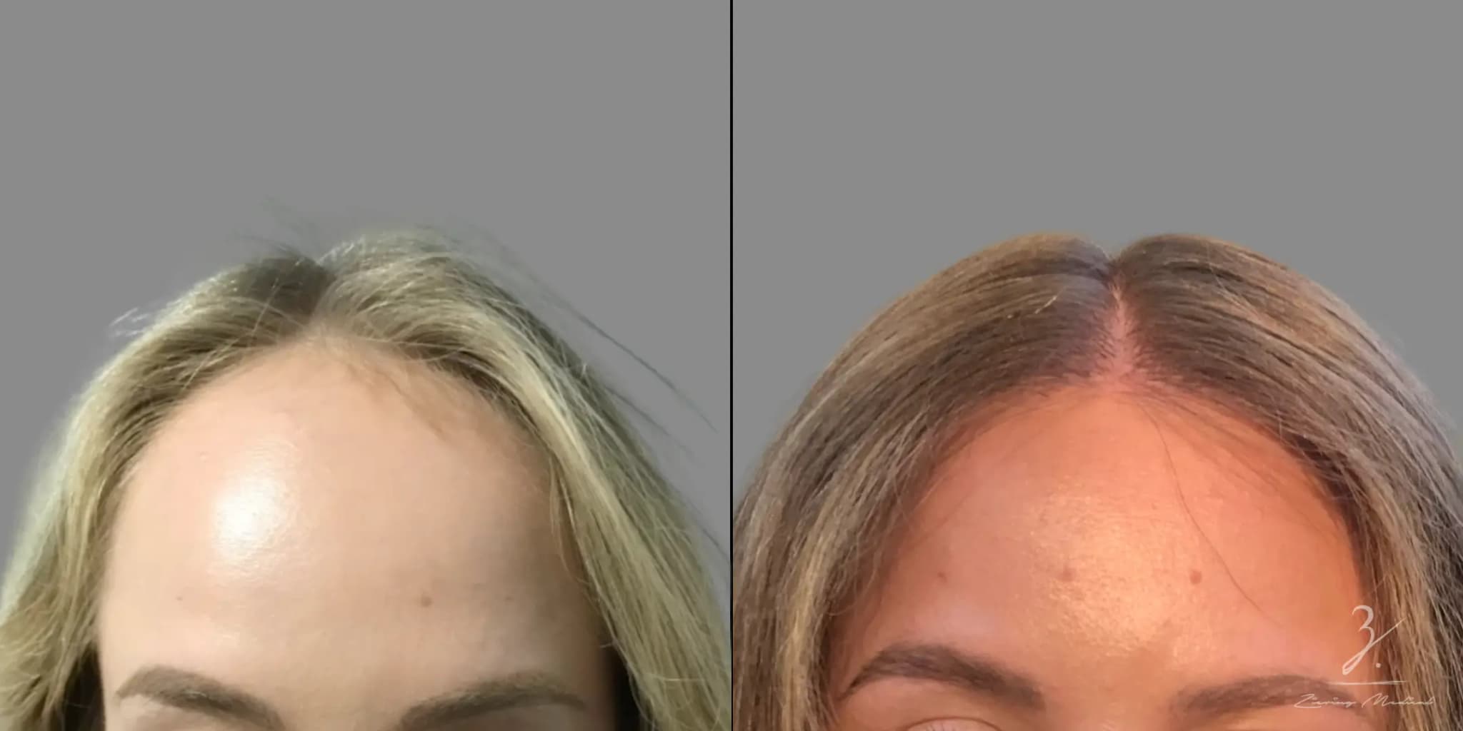 NYC Hair Replacement for a Natural Look