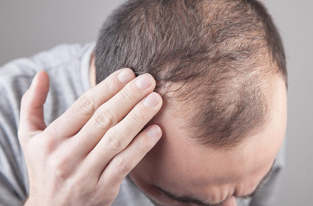 Hair transplant Turkey: Expert Surgeons You Can Trust