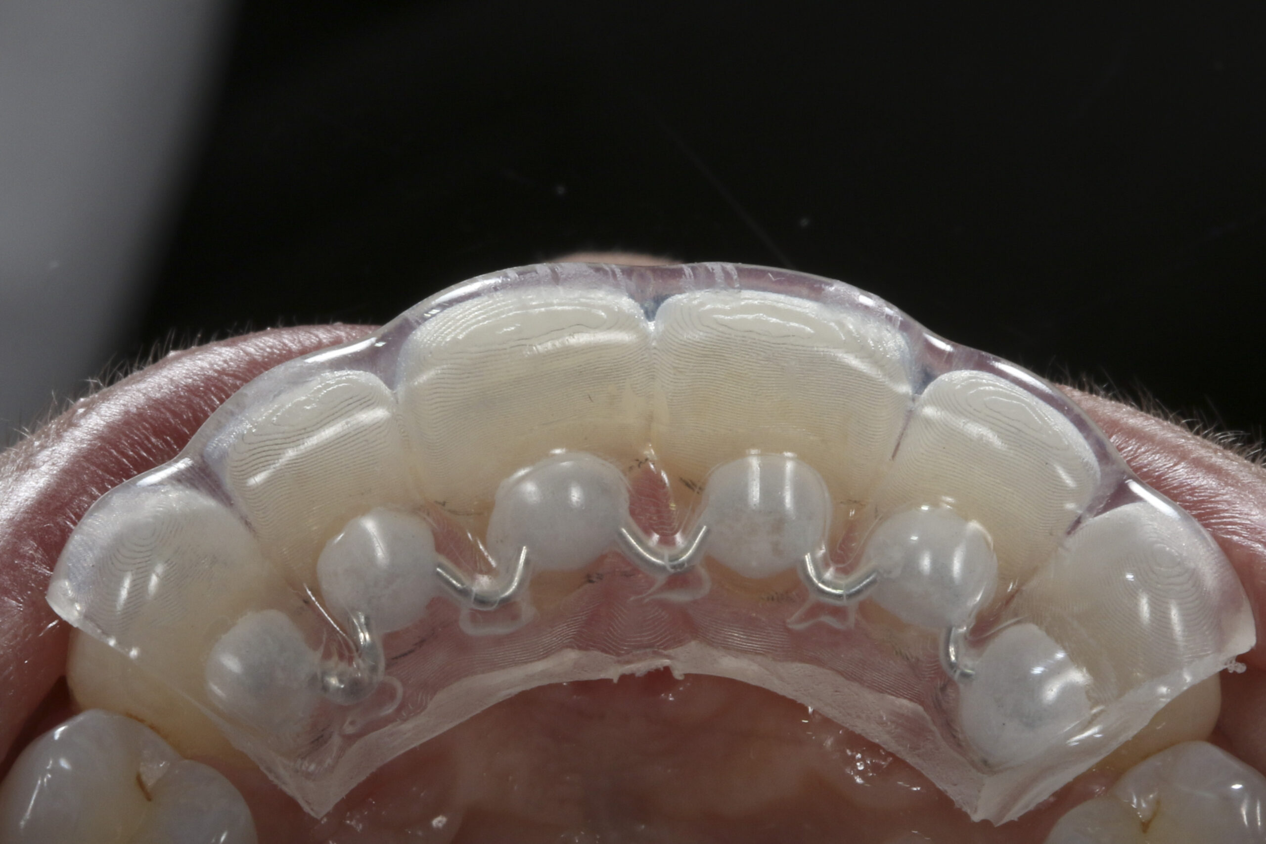 Fixed Retainer Options to Maintain Your Perfect Smile