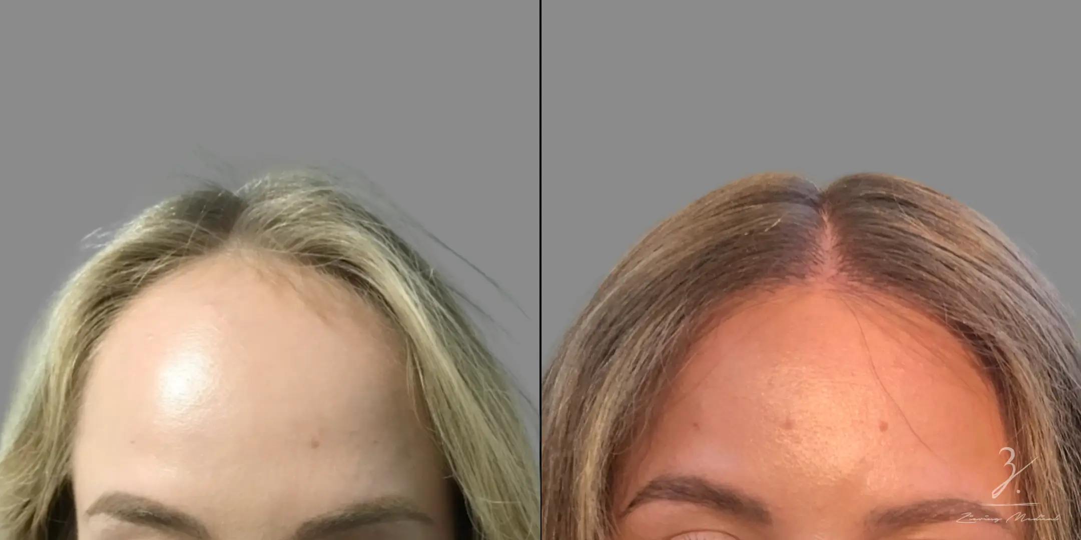 NYC Hair Replacement for a Natural Look