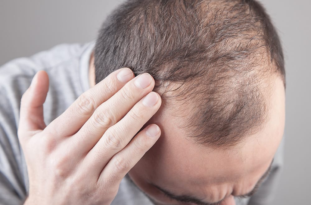 Hair transplant Turkey: Expert Surgeons You Can Trust